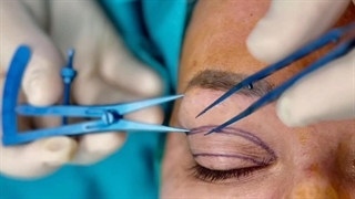 عمل زیبایی افتادگی هردو پلک | بلفاروپلاستی