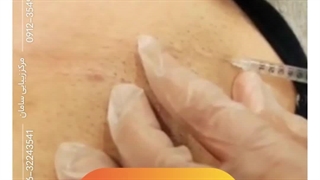 تزریق تخصصی بوتاکس در کرج