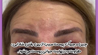 تزریق بوتاکس جرمگیری