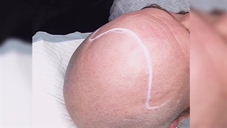 روش اسکالپ سر (میکروپیگمنتیشن مو سر)