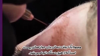 پلاسما تراپی برای جوانسازی پوست تزریق چربی