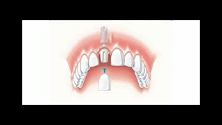 متخصص ایمپلنت