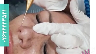 کوچک کردن بینی پلاسماجت ابرسانی پوست