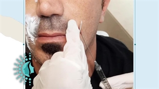 هزینه تزریق ژل خط خنده