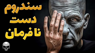 سندروم دست نافرمان