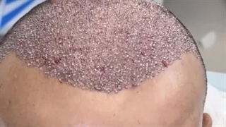 کاشت موی طبیعی بدون جراحی