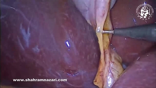 آناتومی (ساختار) ناودان رووییر مشاهده شده در طی کوله‌سیستکتومی لاپاراسکوپی