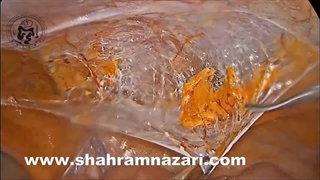 ترمیم هرنی مغبنی مستقیم در دوطرف بروش لاپاراسکوپی