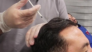 هیر فیلر مزو سر و اوزون تراپی در کلینیک آوینا