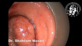 عمل جراحی پولیپ بزرگ انتهای روده بزرگ(رکتوم)