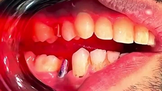 کلینیک دکتر الهه صادقی پوسیدگی دندان